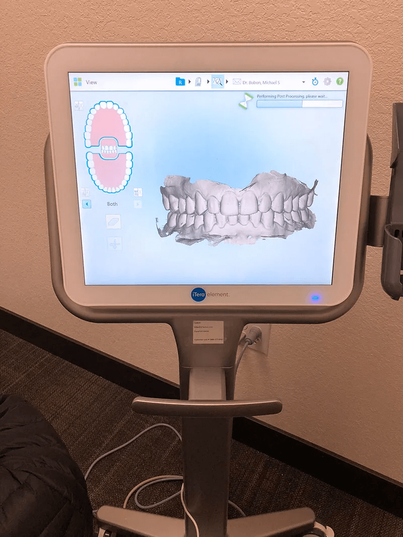 Iteroscanner Teeth
