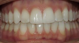 Teeth After Braces