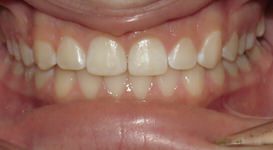 Teeth After Braces