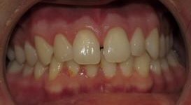 Teeth Before Invisalign