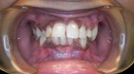 Teeth After Invisalign treatment