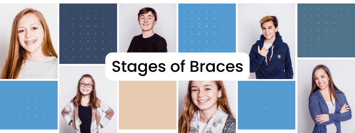 stages of braces