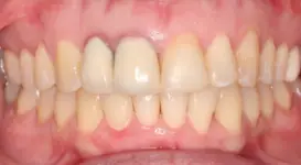 Charmine After DPO
