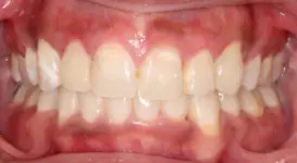 Darryl DPO after teeth