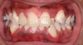 Darryl DPO before teeth