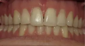 Donovan After teeth