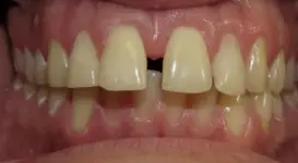 Donovan Before teeth