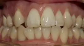 Elizabeth before Teeth