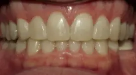 Jason Bubon After DPO teeth
