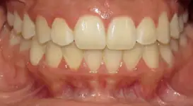 Mya Bubon DPO after teeth