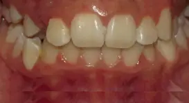 Mya Bubon DPO before teeth